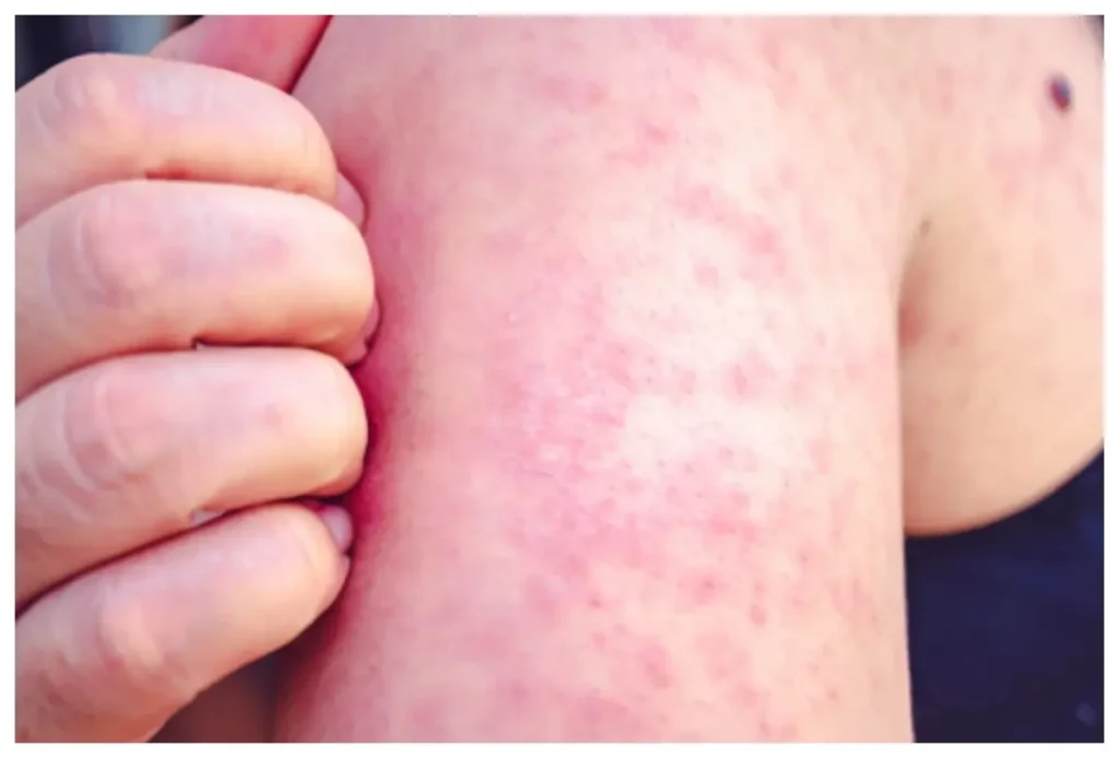 México reporta 24 fallecimientos y casi seis mil contagios de sarampión